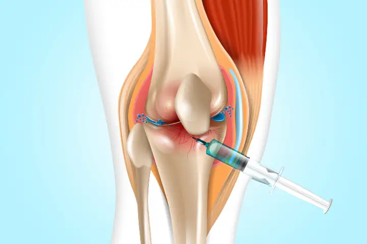 knee joint injection
