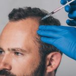 Safe Alopecia Solutions Restoring Confidence And Promoting Long-Term Hair Stability